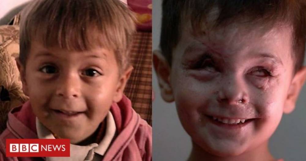 Այս երեխայի դեմքը այլանդակվել է Սիրիայի պատերազմի ժամանակ. սա պատերազմի ողջ արտացոլանքն է (Photo)