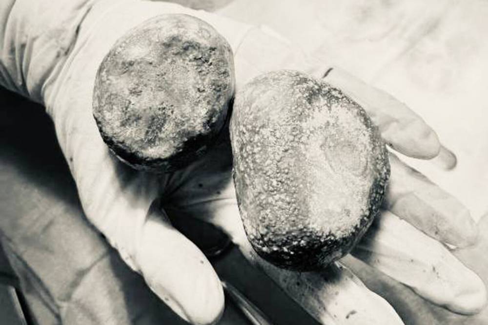 Բժիշկները կնոջ մարմնից երկու հսկա քար են հանել