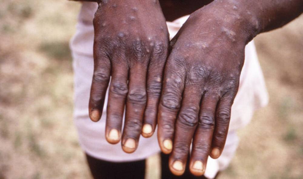 Հնդկաստանում հայտնել են՝ կապիկի ծաղկից մահվան առաջին հնարավոր դեպքի մասին