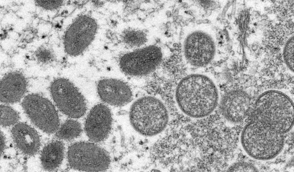 Իսպանիայում կապկի ծաղիկ վարակի բռնկում է գրանցվել․ պատճառը դաջվածքի սրահն էր