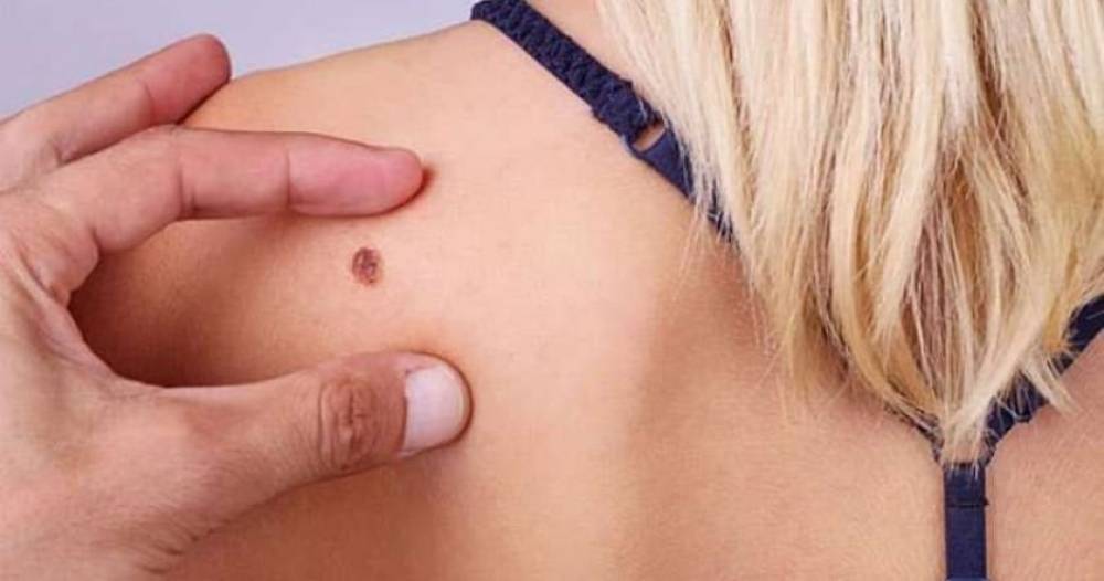 Բժիշկը խոսել է խալերի մահացու փոփոխությունների մասին